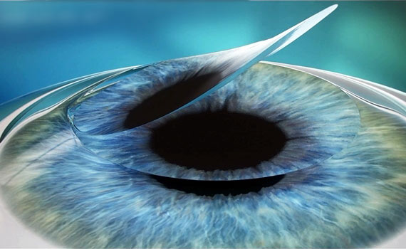 femto_lasik3